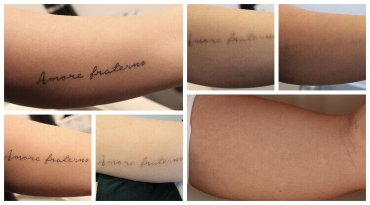 6 bilder med arm fra kunde. På siste bilde er tatovering fjernet. 