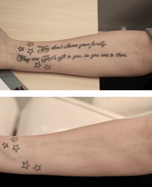 Erfaring fra kunde som viser arm der tatovering er nesten hundre prosent fjernet