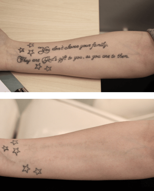 Før og etter tatoveringsfjerning Erfaring fra kunde som viser arm der tatovering er nesten hundre prosent fjernet
