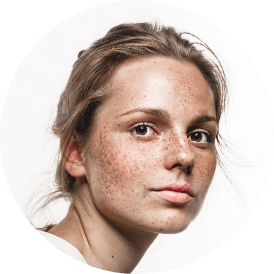 Pigmentflekker ansikt Ung kvinne ser inn i kameraet. Hun er klar for behandling av pigmentflekker ved Remove Hudklinikk.
