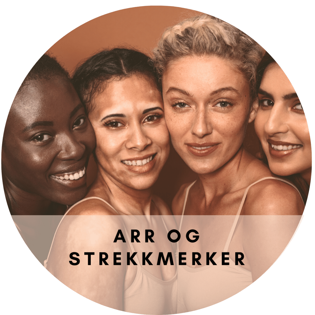 Arr og strekkmerker behandlinger