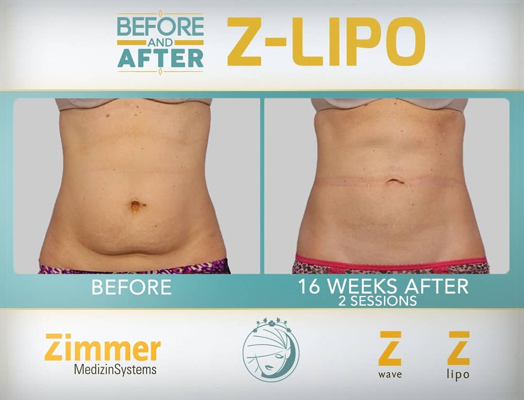 Z Lipo before after 2