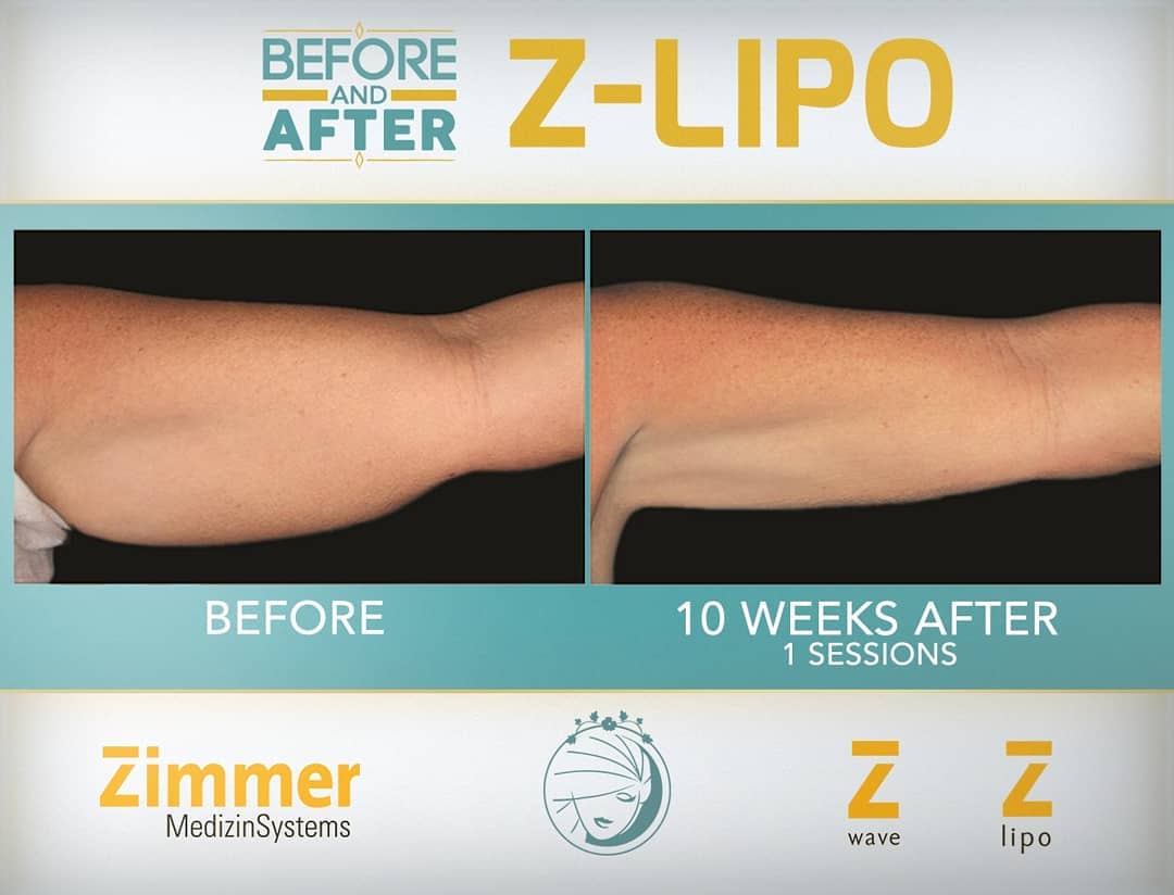 Z Lipo before after