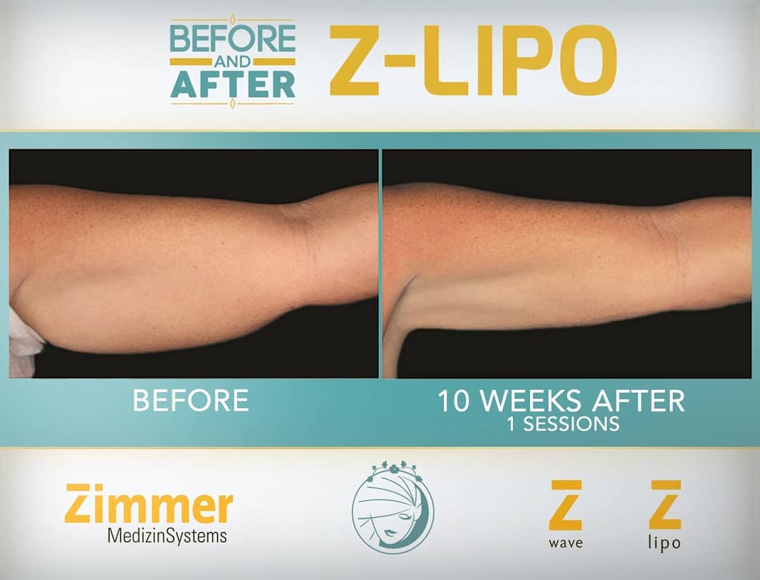Z Lipo before after Z Lipo before after