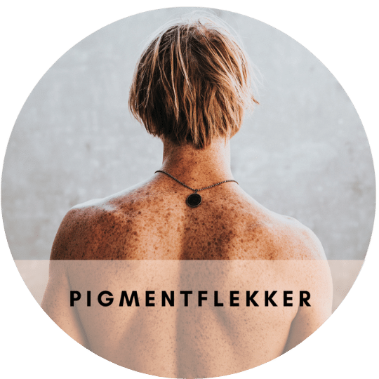 Vår laser kan bli kvitt uønsket pigmentflekk