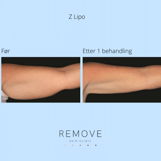 Z Lipo arm Til venstre vises underarm med fett forut for Z-lipo behandling. Til høyre vises underarmen uten fett etter Z-lipo behandling