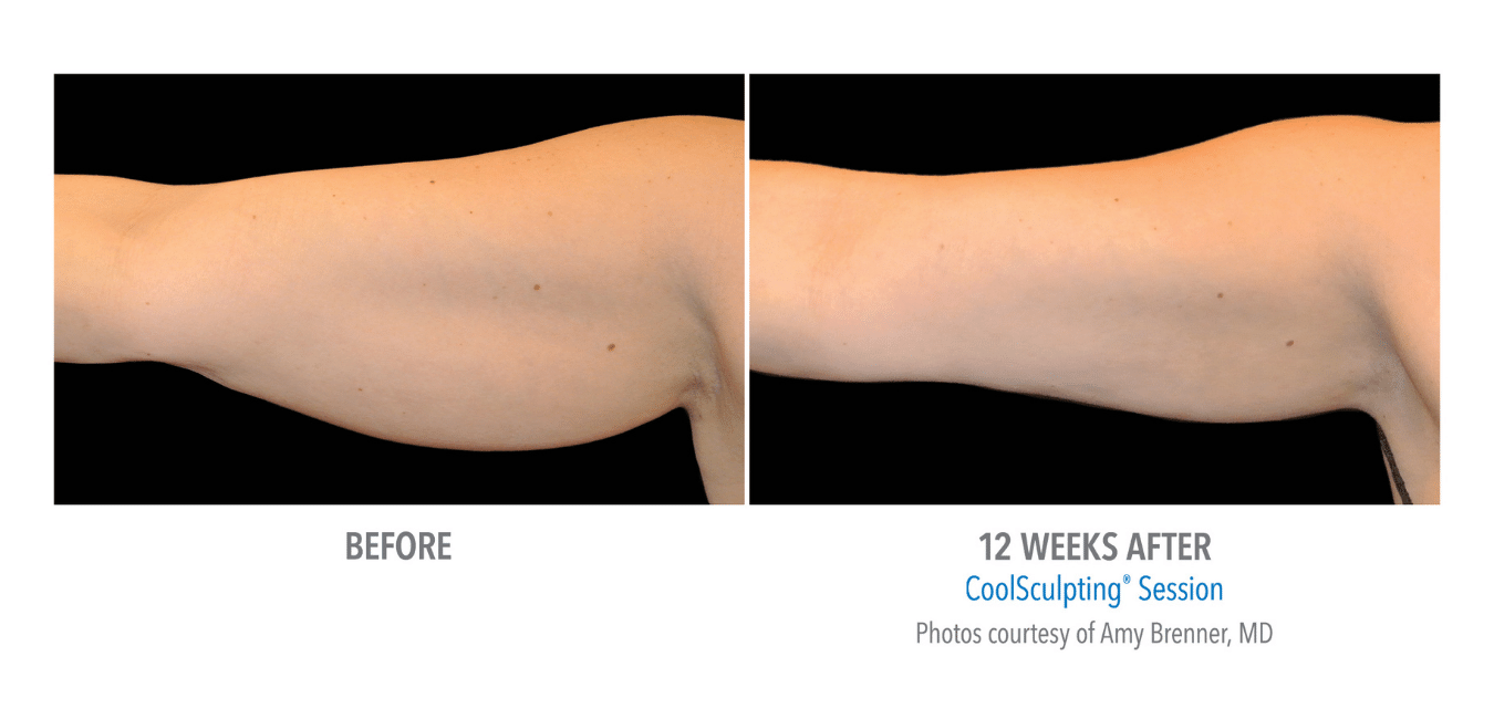 Til venstre vises overarm med fett forut for CoolSculpting behandling. Til høyre vises overarmen uten fett etter CoolSculpting behandling