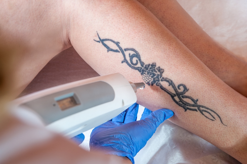 spesialist fjerner tatovering på benet med maskin