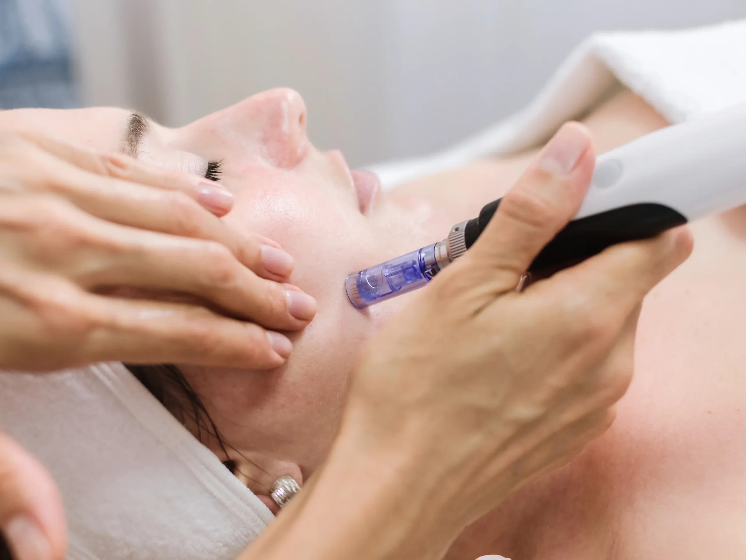 Dermapen microneedling prosedyre utført på en klient ved Remove hudklinikk for hudfornyelse og forbedring