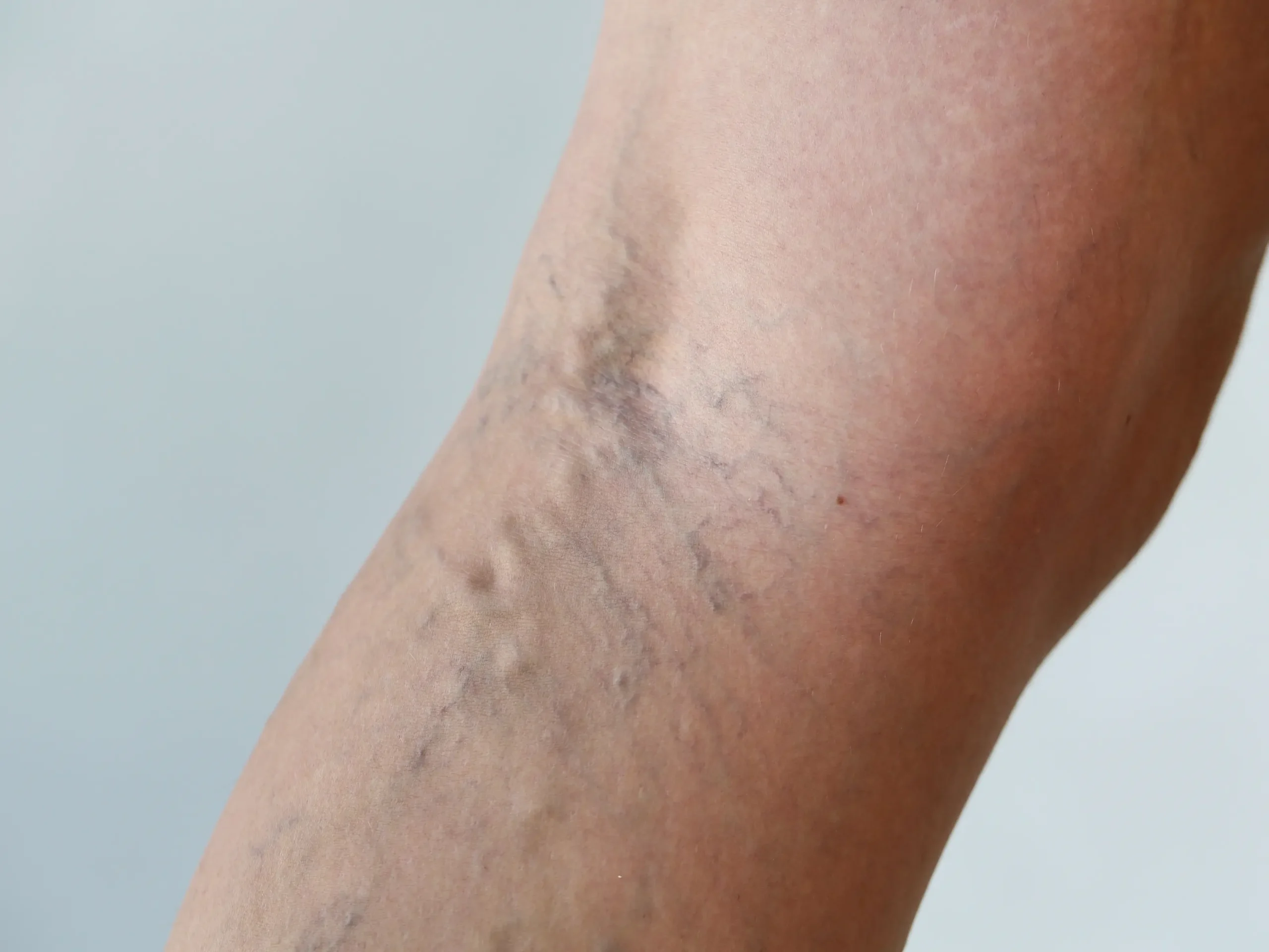 Behandling av sprengte blodkar ved Remove hudklinikk, hvor en terapeut bruker laser på en pasients ben.